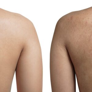 Soin du dos a limoges soin acné du dos en institut à Limoges