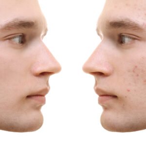 Soin du visage anti acné pour homme Limoges