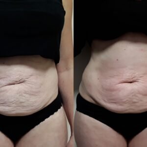 Radiofréquence ventre à Limoges : un soin innovant pour éliminer la graisse abdominale, raffermir la peau et retendre le ventre naturellement. Résultats visibles dès les premières séances : ventre plus plat, peau plus ferme, silhouette redessinée.