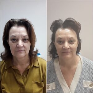 Lifting naturel par radiofréquence Limoges
